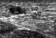 Why CHIVA is the Safer Choice for Small Saphenous Vein Reflux: A Focus on Nerve Preservation