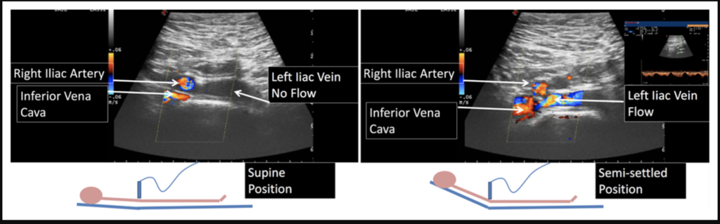 Many of these 'compressions' simply disappear when the patient sits up.